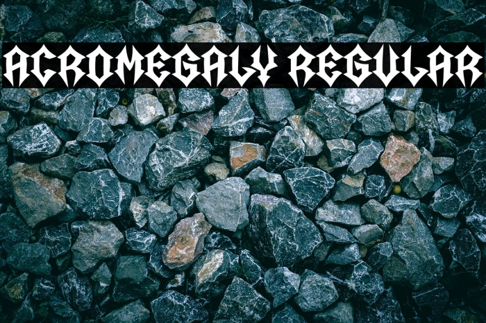 Acromegaly Regular Example 3