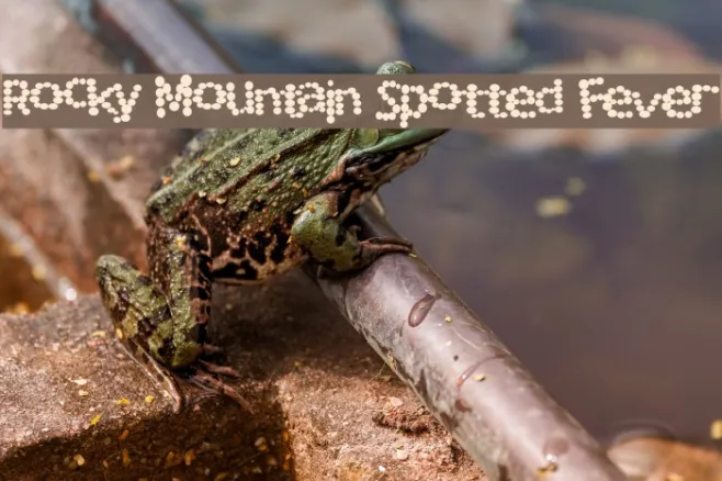 Rocky Mountain Spotted Fever Example 1